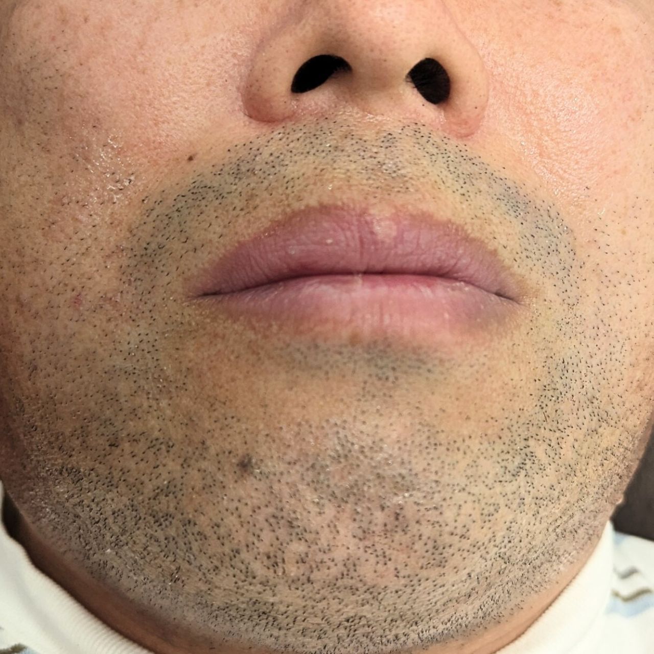 ヒゲ脱毛施術前 50代