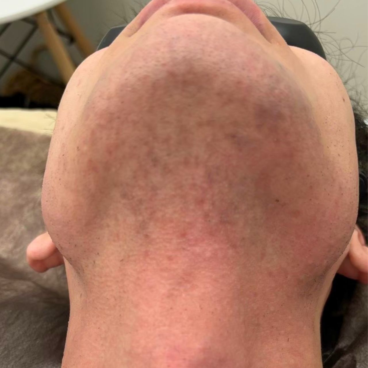 ヒゲ脱毛施術後