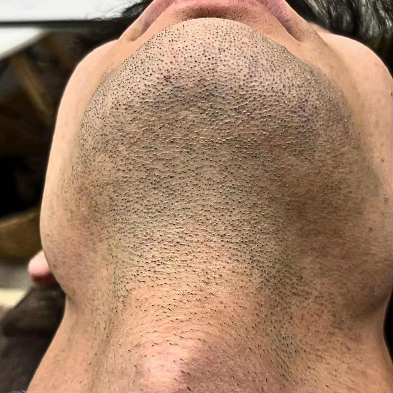 ヒゲ脱毛施術前